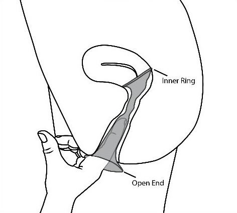 A finger pushes the inner ring of the internal condom into the vagina. The open end is outside of the vagina.