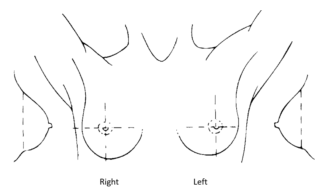 Pain drawing of a female body. The pain location area borders were not