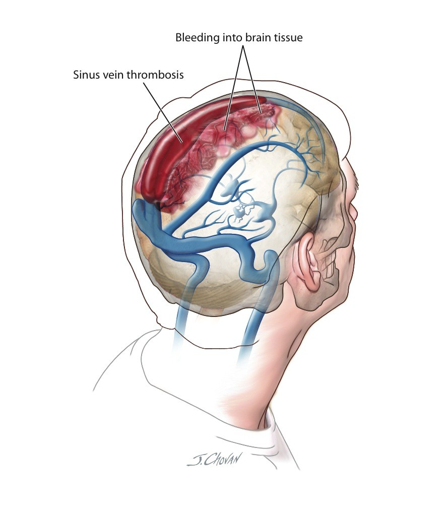 Sinus vein thrombosis with bleeding into brain tissue