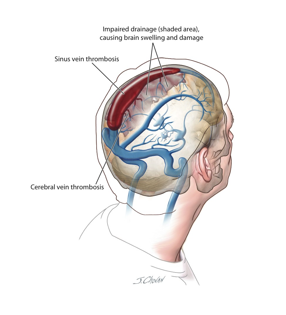 CVT causing brain swelling