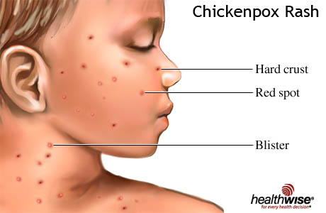 Chickenpox rash © HealthWise