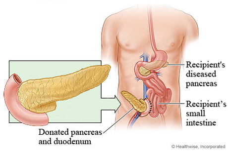 Pancreas transplant, showing both recipient's diseased pancreas and where the donated pancreas is attached.