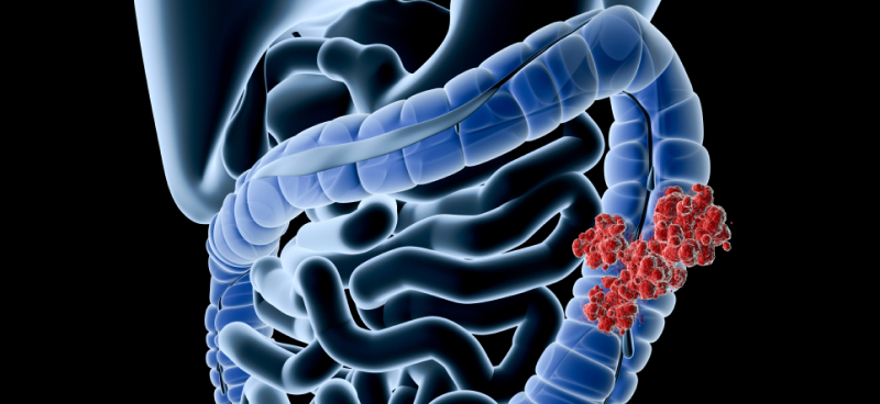 Using MyChart for IBD care