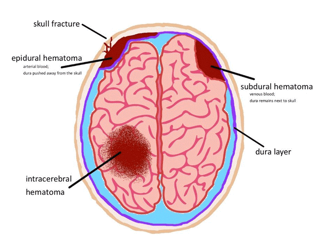Types of bleeding in the brain