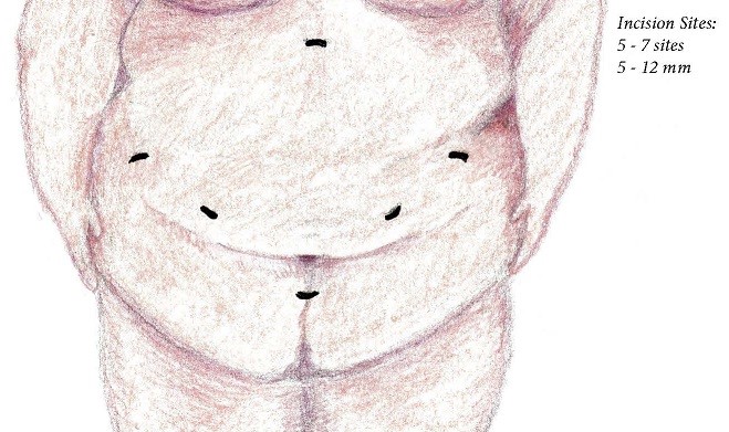 Bariatric surgery incision sites