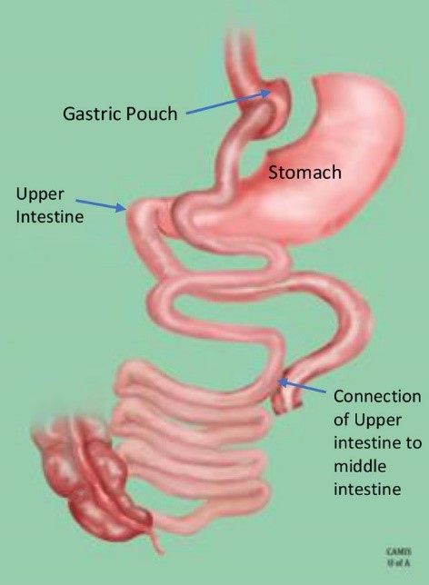 How bariatric surgery works—a gastric pouch and new connections of the small intestine