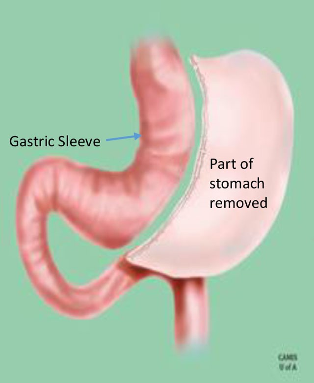 A sleeve gastrectomy removes most of the stomach to make a sleeve