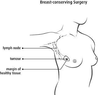 Dotted line showing the tumour and margin that are removed in breast-conserving surgery. Lymph nodes are not removed.