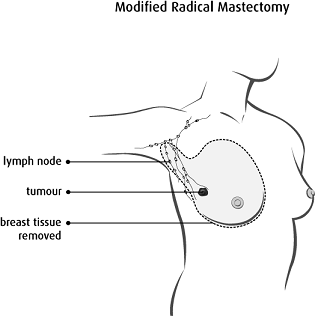 Dotted line showing all breast tissue and lower section of lymph nodes that are removed in a modified radical mastectomy