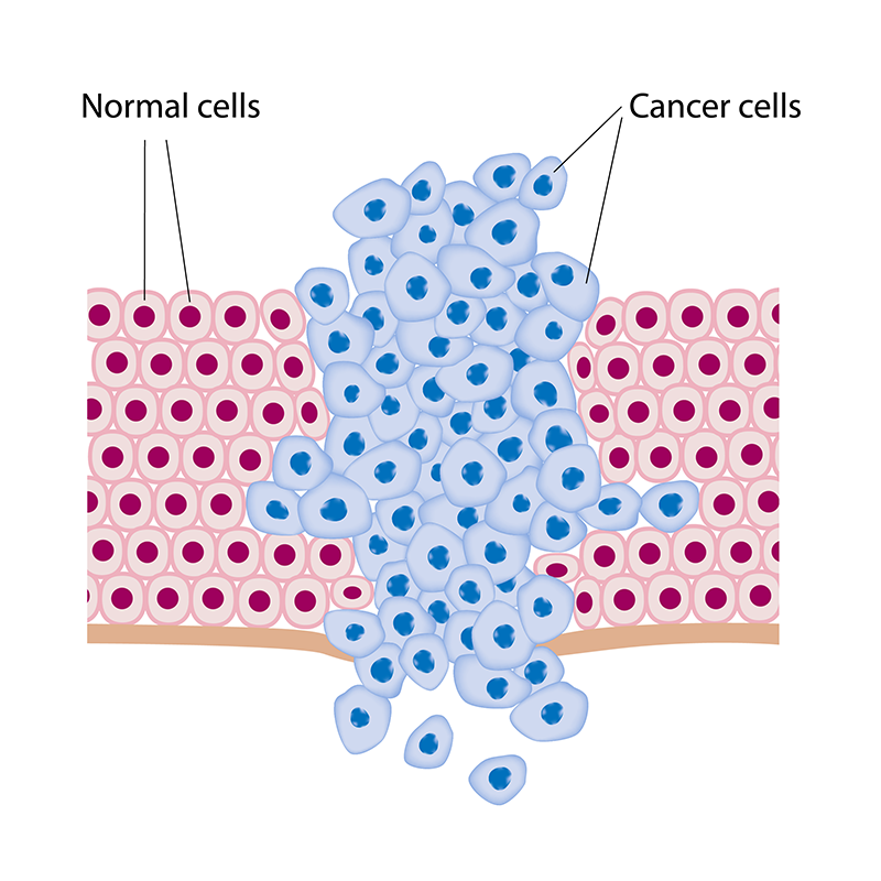 Cancer cells growing out of control compared to normal cells