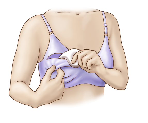Post-Mastectomy: Breast Prostheses and Special Bra Options