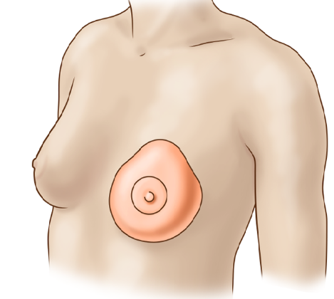 Sponge Breast Prosthesis Bra Suit Women Mastectomy After Breast