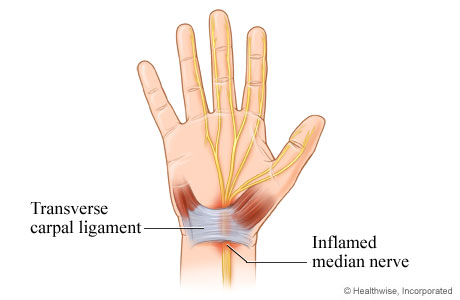 Inflamed median nerve in carpal tunnel branches into nerves in the thumb, index finger, middle finger, and ring finger.