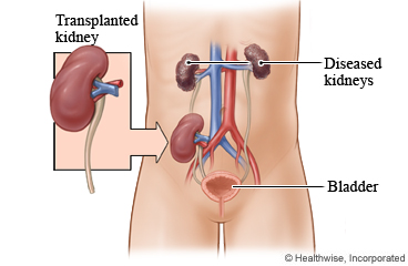 Diagram of where a transplanted kidney is usually placed in the body.