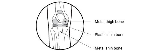 Front view after a knee replacement, metal thigh bone, plastic shin bone, and metal shin bone