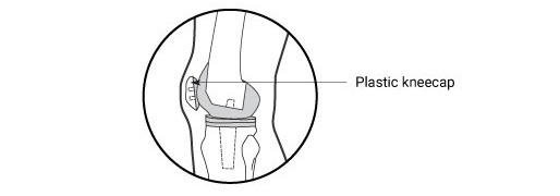 Side view after a knee replacement, plastic knee cap