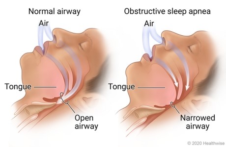 Image of a normal open airway and one with obstructive sleep apnea where the airway is narrowed in the throat.