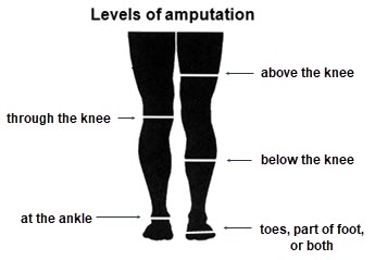 Levels of Amputation