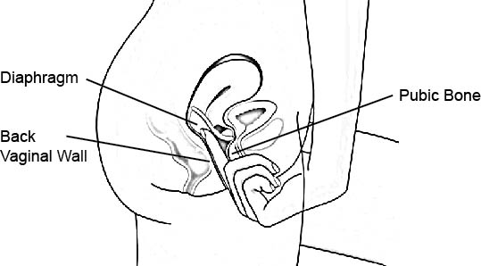 How to insert a diaphragm