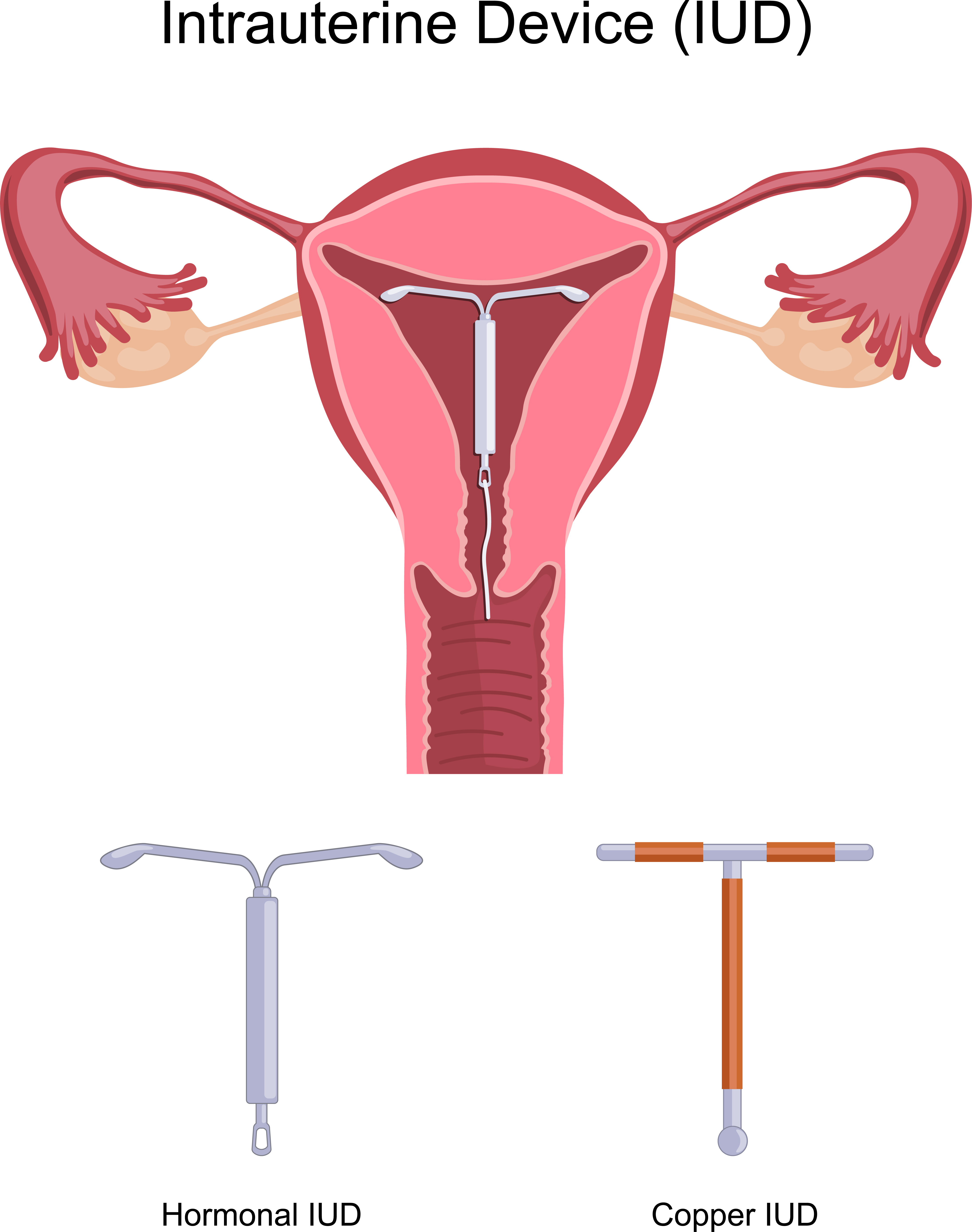 IUD in the uterus, with strings coming out of the cervix.