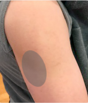Between skin and muscle of upper arm. The injection site is shaded