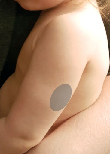 Between Skin and Muscle of Upper Arm (Subcutaneous)