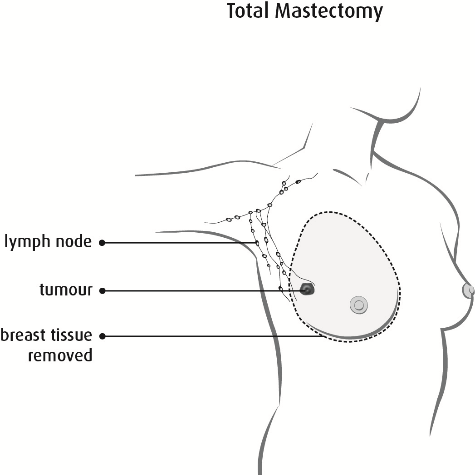 Dotted line showing all breast tissue that is removed in a total mastectomy. Lymph nodes are not removed.